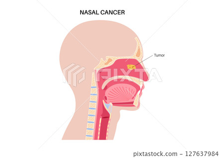 Nasal cancer poster 127637984