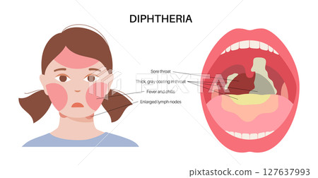 Diphtheria oral disease Diphtheria oral disease 127637993