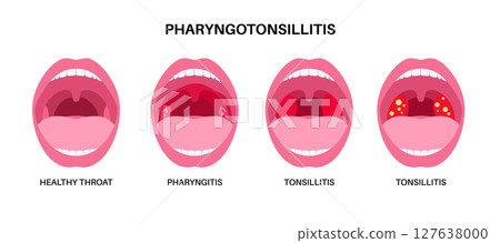 Pharyngotonsillitis oral disease 127638000
