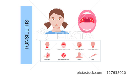 Tonsillitis Oral Desease Tonsillitis Oral Desease 127638020