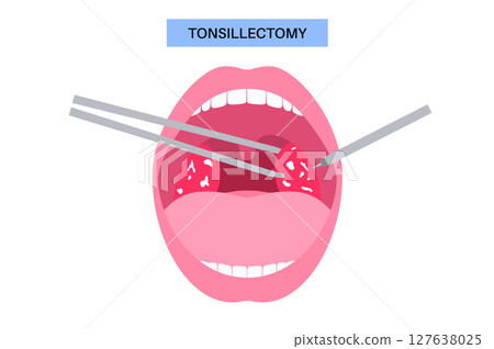 Tonsillectomy procedure poster 127638025