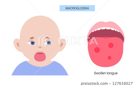 Macroglossia medical poster Macroglossia medical poster 127638027