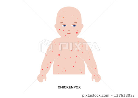 Varicella medical poster 127638052