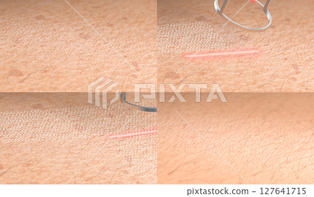 Old wrinkled skin surface laser resurfacing macro procedure 127641715