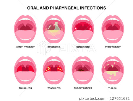 Oropharyngeal infections poster Oropharyngeal infections poster 127651681