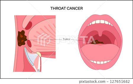 Throat cancer poster 127651682