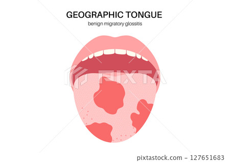 Geographic tongue poster Geographic tongue poster 127651683