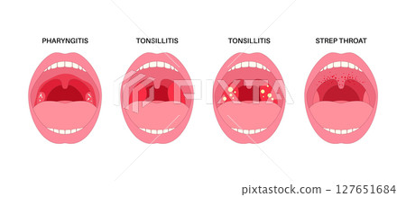 Pharyngotonsillitis oral disease 127651684