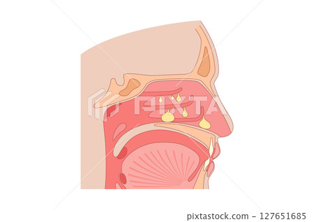 Nasal Polyps poster Nasal Polyps poster 127651685