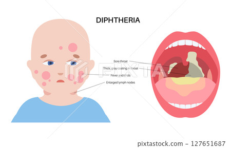 Diphtheria oral disease 127651687