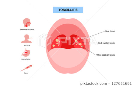 Tonsillitis Oral Desease Tonsillitis Oral Desease 127651691