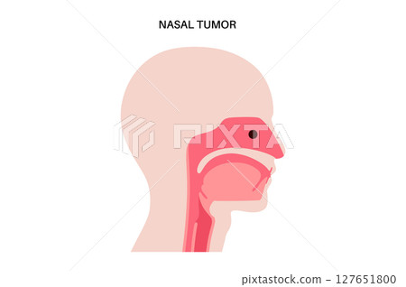 Nasal cancer poster 127651800