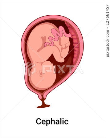 Cephalic baby positions in the uterus during pregnancy. Pathology. Detailed medical vector illustration. Fetus with umbilical cord, placenta. 127661457