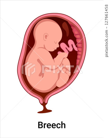 Breech baby positions in the uterus during pregnancy. Pathology. Detailed medical vector illustration. Fetus with umbilical cord, placenta. 127661458