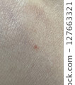 Eczema red skin skin close-up 127663321