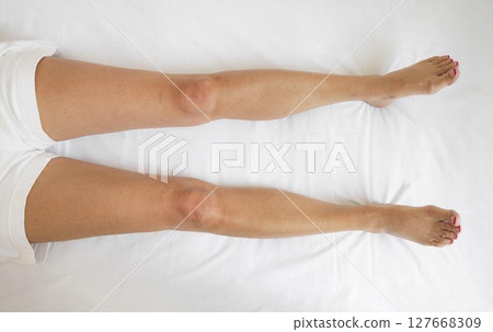 closeup of woman legs lying flat on white bed in bright medical setting, swelling, concept of lymphedema diagnosis, recovery, orthopedic assessment, physical therapy care 127668309