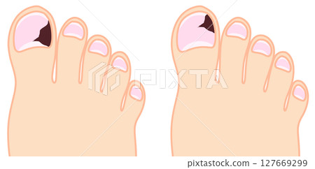 Nail internal bleeding progress set Nail internal bleeding progress set 127669299