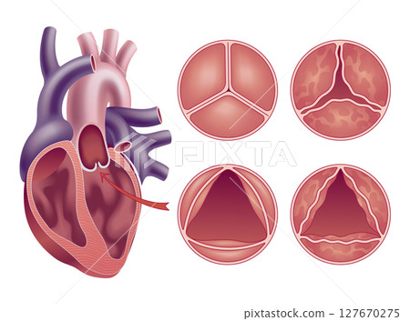 Medical illustration shows the difference between a normal aortic valve and one with stenosis, open and closed, and its location in the heart, with annotations Medical illustration shows the difference between a normal aortic valve and one with stenosis, open and closed, and its location in the heart, with annotations 127670275