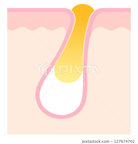 Cross-section of a pore clogged with keratin plugs Cross-section of a pore clogged with keratin plugs 127674702