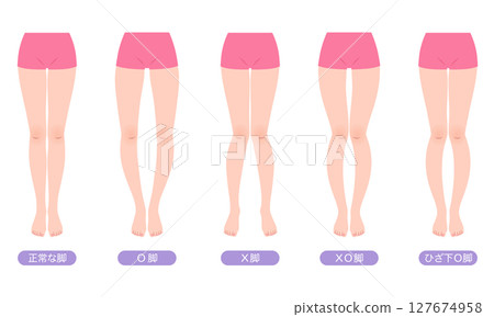 Leg distortion, bow leg correction, pelvic distortion 127674958