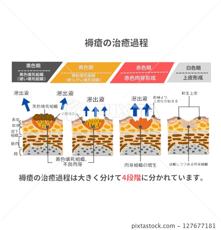 醫學插畫展示褥瘡癒合過程 | 從黑色變成黃色、紅色、白色 醫學插畫展示褥瘡癒合過程 | 從黑色變成黃色、紅色、白色 127677181