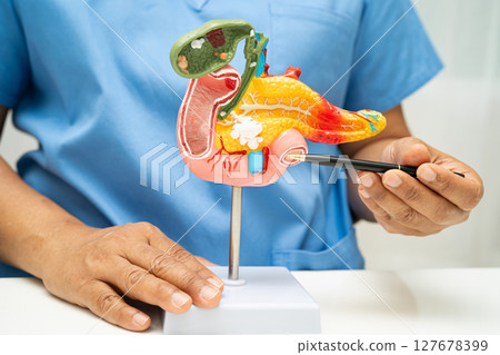 Pancreatitis, pancreatic cancer, Asian doctor with pancreas, gallbladder and bile duct human anatomy model at hospital. 127678399