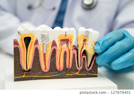 Asian dentist holding dental implant, artificial tooth roots into jaw, root canal of dental treatment, gum disease, teeth model for dentist. 127678401