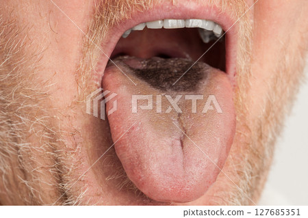 Black hairy tongue closeup Black hairy tongue closeup 127685351