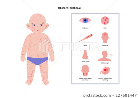Measles or rubeola symptoms. Measles or rubeola symptoms. 127691447