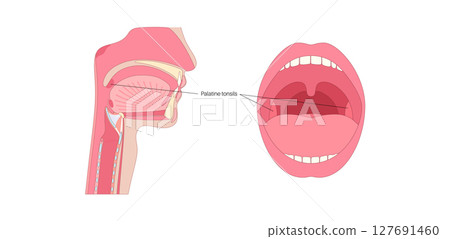 Palatine tonsils poster Palatine tonsils poster 127691460