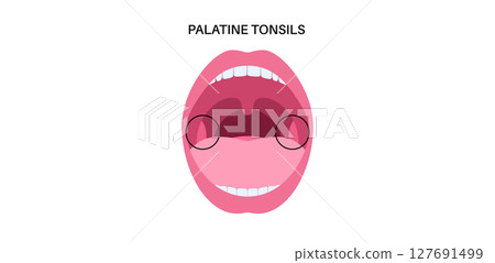 Palatine tonsils poster 127691499