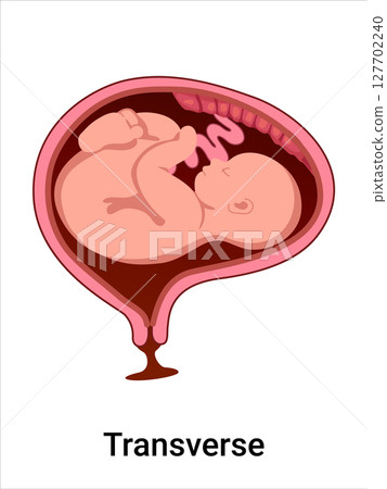 Transverse baby positions in the uterus during pregnancy. Pathology. Detailed medical vector illustration. Fetus with umbilical cord, placenta. 127702240