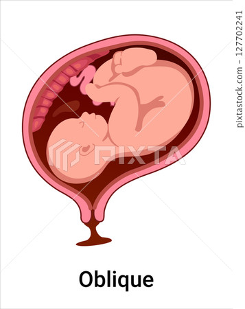 Oblique baby positions in the uterus during pregnancy. Pathology. Detailed medical vector illustration. Fetus with umbilical cord, placenta. 127702241