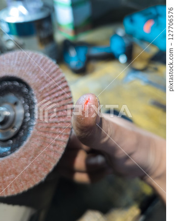 Injured finger and flap disc on angle grinder Injured finger and flap disc on angle grinder 127706576