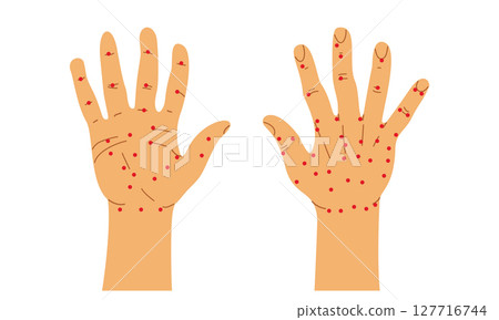 Chinese Acupuncture on Human Right Hand. Palm and Back of the Hand Vector Illustration. 127716744