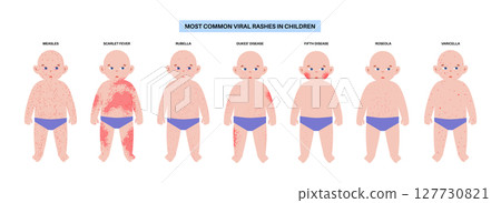 The most common viral rashes The most common viral rashes 127730821