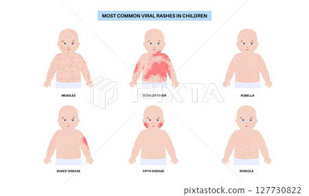 The most common viral rashes The most common viral rashes 127730822