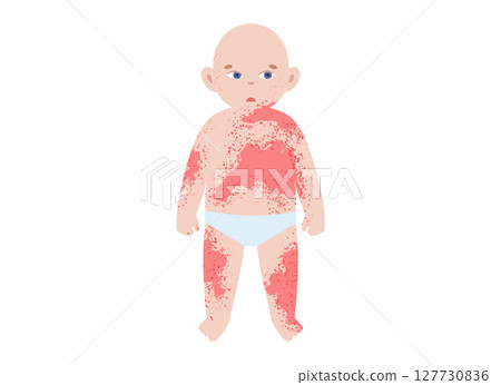 The most common viral rashes 127730836