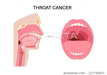Throat cancer poster Throat cancer poster 127730837