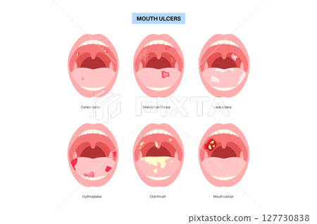 Types of mouth ulcer 127730838