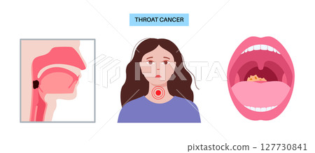 Throat cancer poster 127730841