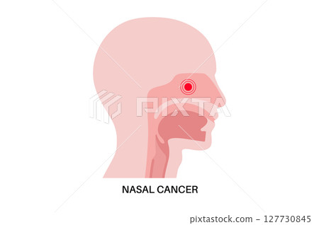 Nasal cancer poster 127730845