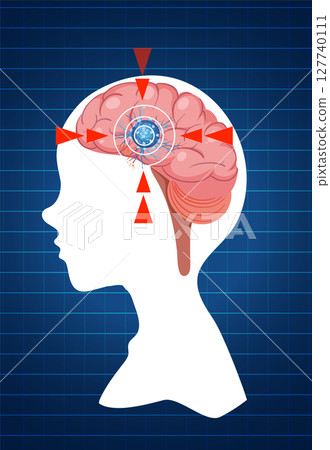 Human Brain with Cancer Cell Illustration 127740111