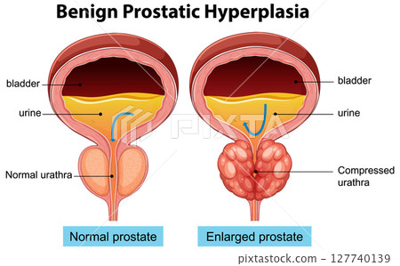 Comparison of Normal and Enlarged Prostate Glands 127740139