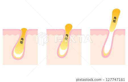 角蛋白堵塞毛孔的橫切面 角蛋白堵塞毛孔的橫切面 127747181