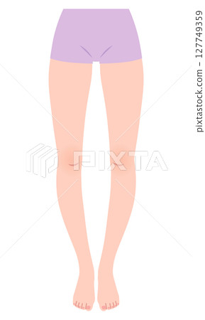 Bow legs, leg distortion, bow leg correction, pelvic distortion 127749359