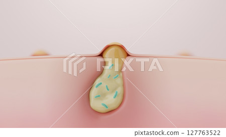 Cross-section of inflamed and suppurating acne and pores. Causes of skin troubles and acne bacteria CG. Cross-section of inflamed and suppurating acne and pores. Causes of skin troubles and acne bacteria CG. 127763522