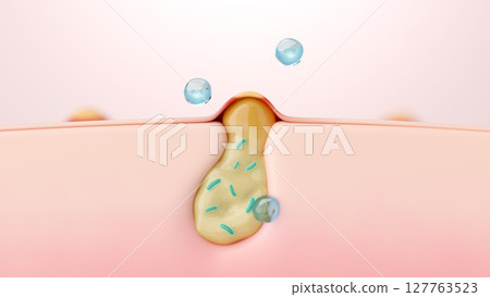 A beauty essence that treats inflammatory acne and acne bacteria. Image of treatment for pores and skin problems. A beauty essence that treats inflammatory acne and acne bacteria. Image of treatment for pores and skin problems. 127763523