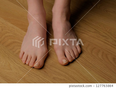 Close-up of a woman s foot with hallux valgus bunion and signs of toenail fungus. Her hand gently touches the deformed big toe, illustrating common foot problems and the need for medical care. Close-up of a woman s foot with hallux valgus bunion and signs of toenail fungus. Her hand gently touches the deformed big toe, illustrating common foot problems and the need for medical care. 127763864