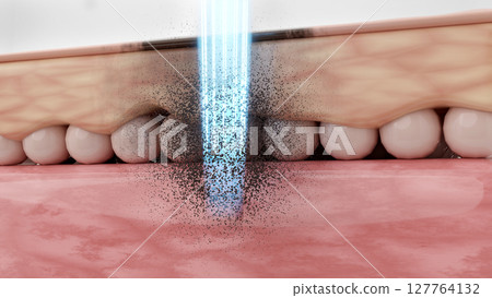 A clean image of a treatment in which a pico laser precisely destroys the melanin that causes spots. A clean image of a treatment in which a pico laser precisely destroys the melanin that causes spots. 127764132